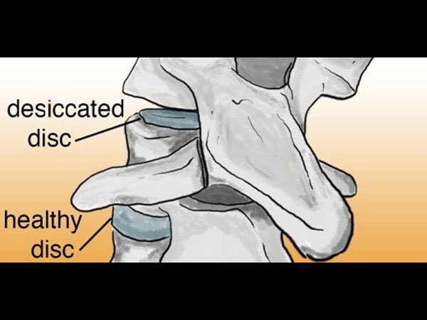 Symptoms-of-Disc Desiccation